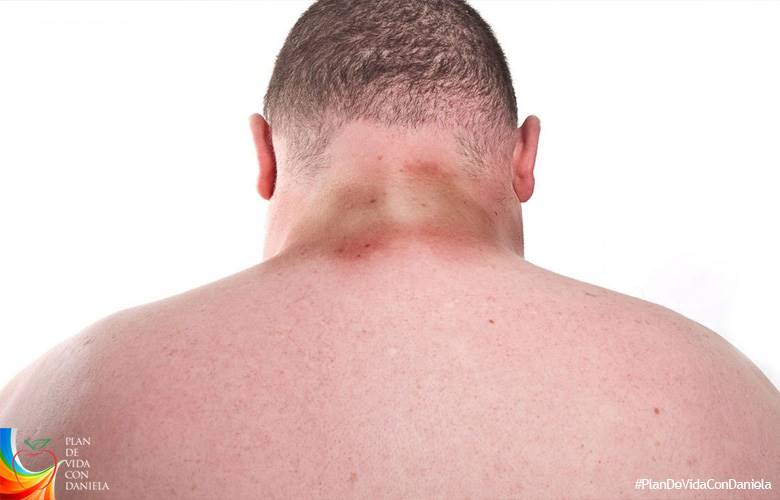 Acantosis nigricans¿qué es esto?