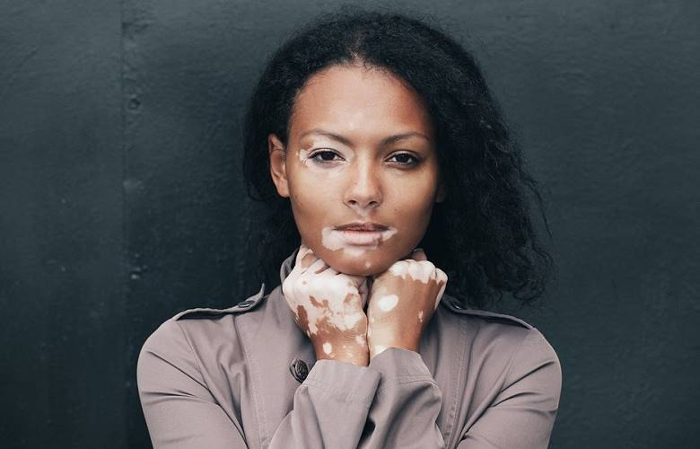 Vitiligo, padecimiento que puede afectar emocionalmente a quien la padece: IMSS