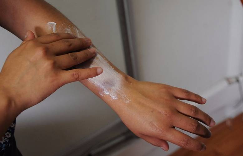 Recomendaciones para prevenir daños en piel durante temporada de calor