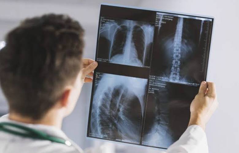 Estudio: acumulaciÃ³n de virus en los pulmones, principal causa de muerte por covid
