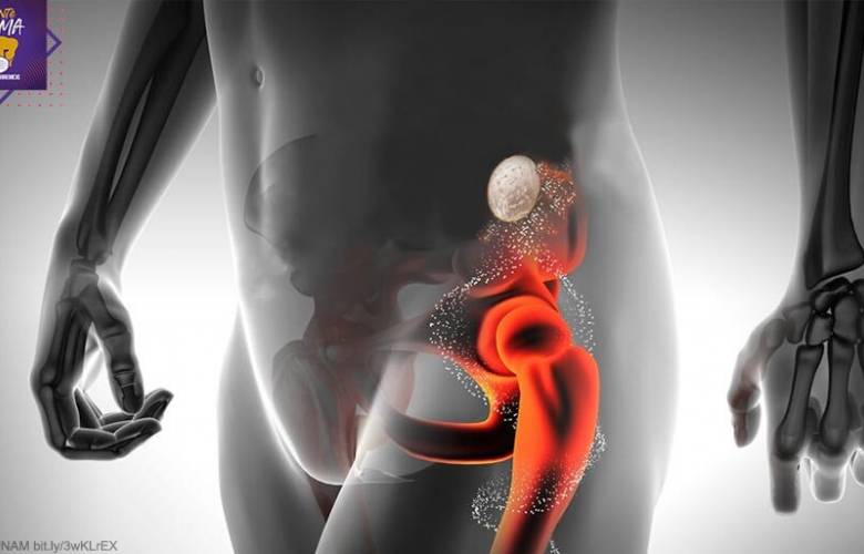 Alumna de la UNAM creó un parche para tratar la osteoporosis
