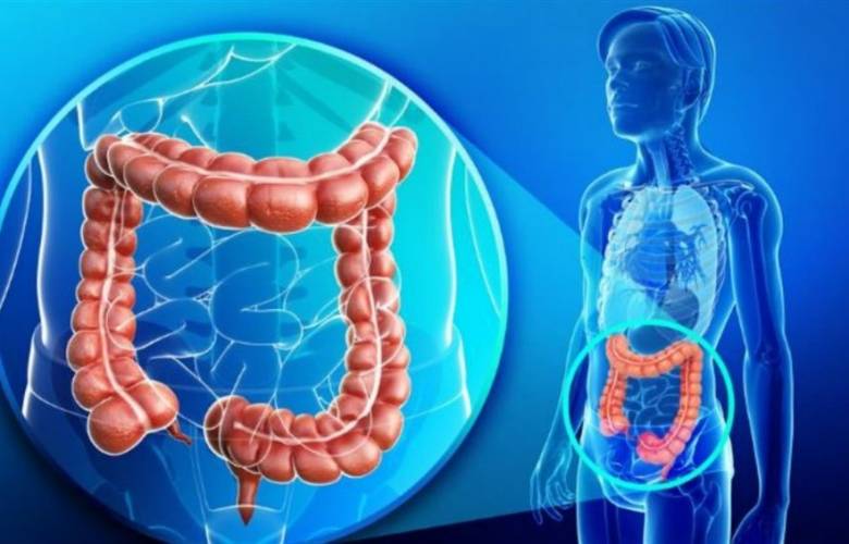 Promueven realizar examen de cáncer de colon desde los 45 