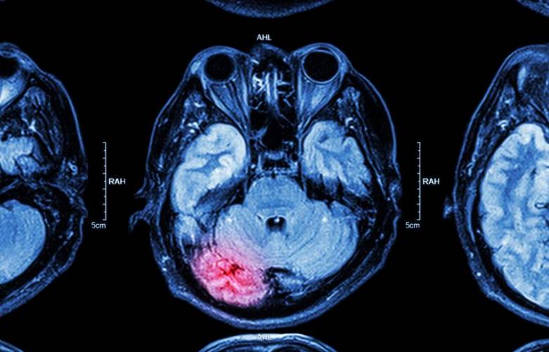 Aumentan infartos cerebrales en el mundo por causa de Covid