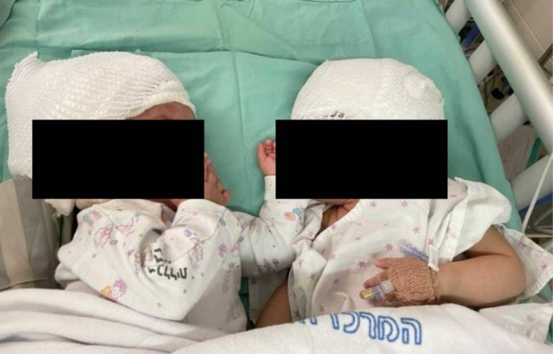Médicos separan con éxito a gemelas unidas por la cabeza